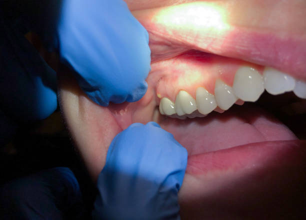 Best Emergency Tooth Extraction in Mar Mac, NC