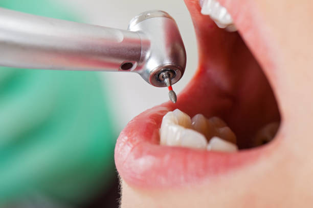 Best Emergency Wisdom Teeth Removal in Mar Mac, NC